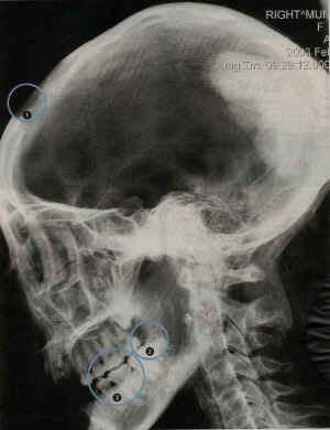 Radiografa de la momia que dicen pertenecer a Nefertiti.